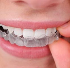 Aligner-Invisalign Aligner-Invisalign