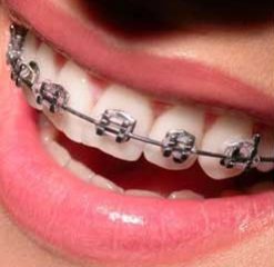 braces-aligner-2 braces-aligner-2
