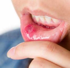 mouth-ulcer mouth-ulcer
